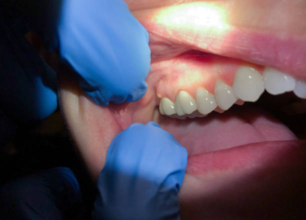 Best Dental Abscess Treatment in Forest, VA